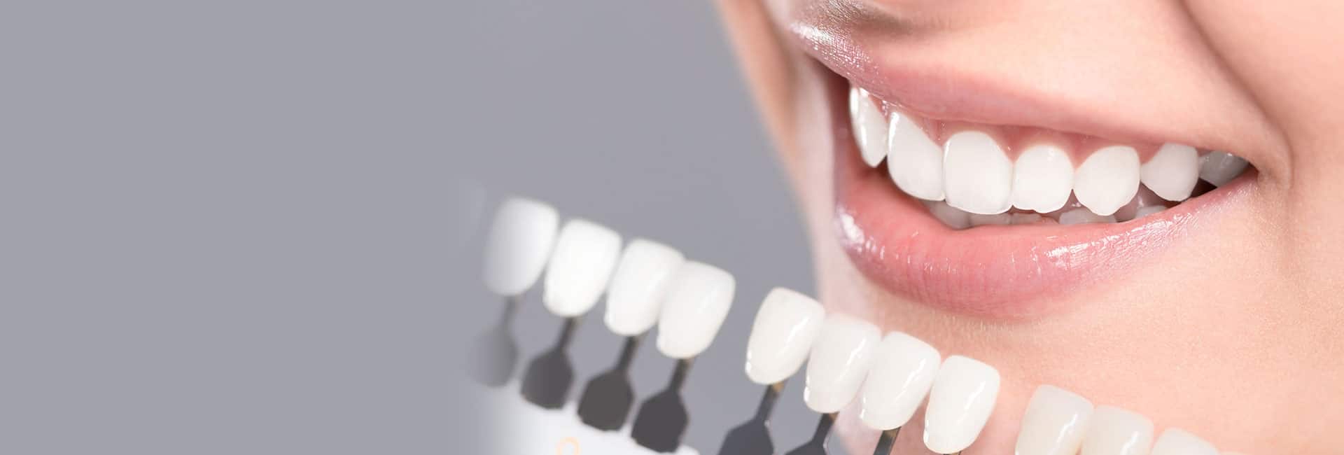 dental veneers millwoods
