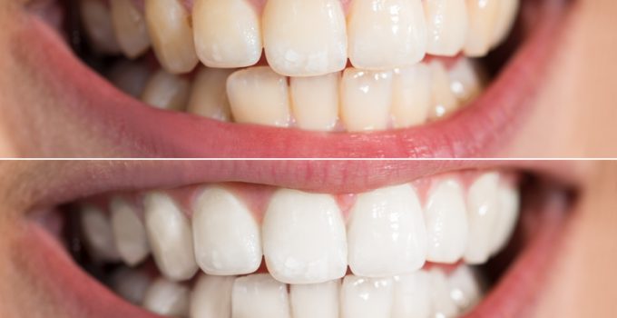 Before and after image of patient after teeth whitening procedure