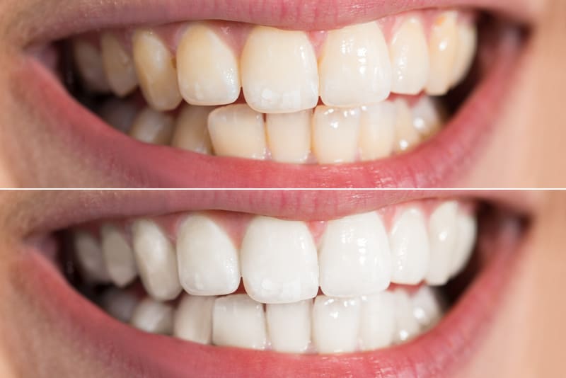 Before and after image of patient after teeth whitening procedure