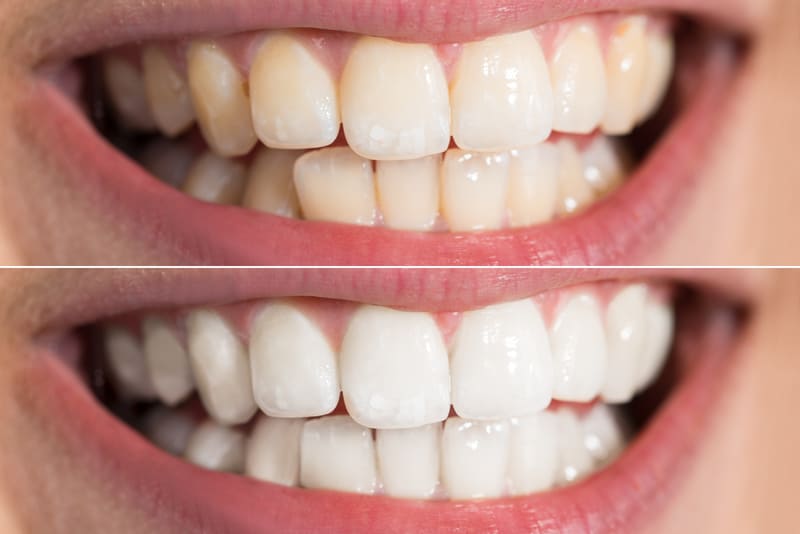 why-teeth-whitening-is-the-most-popular-dental-procedure-today