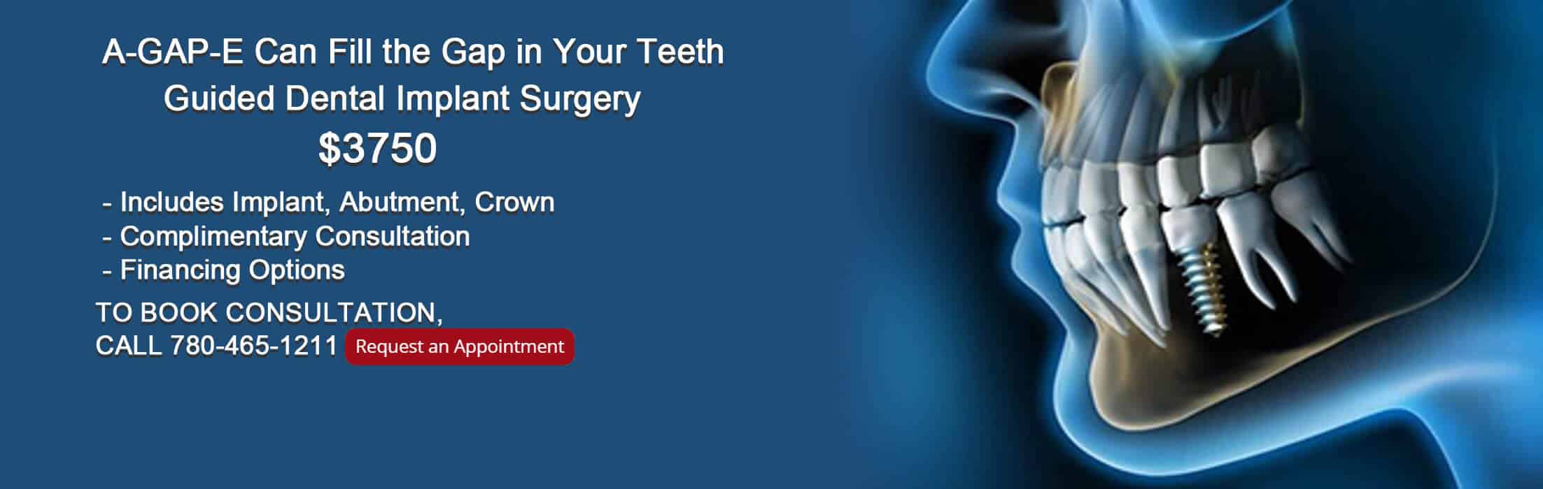 agape dental implant