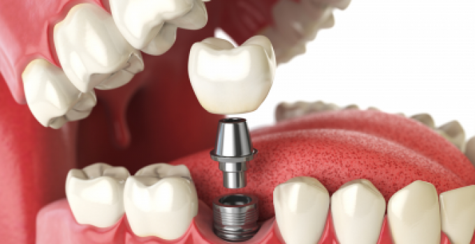 what-are-the-advantages-of-dental-implant-surgery