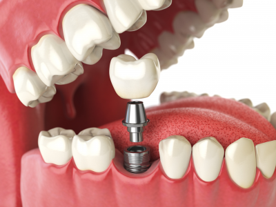 what-are-the-advantages-of-dental-implant-surgery