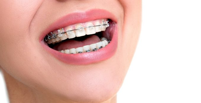 Your Guide to Oral Hygiene with Braces