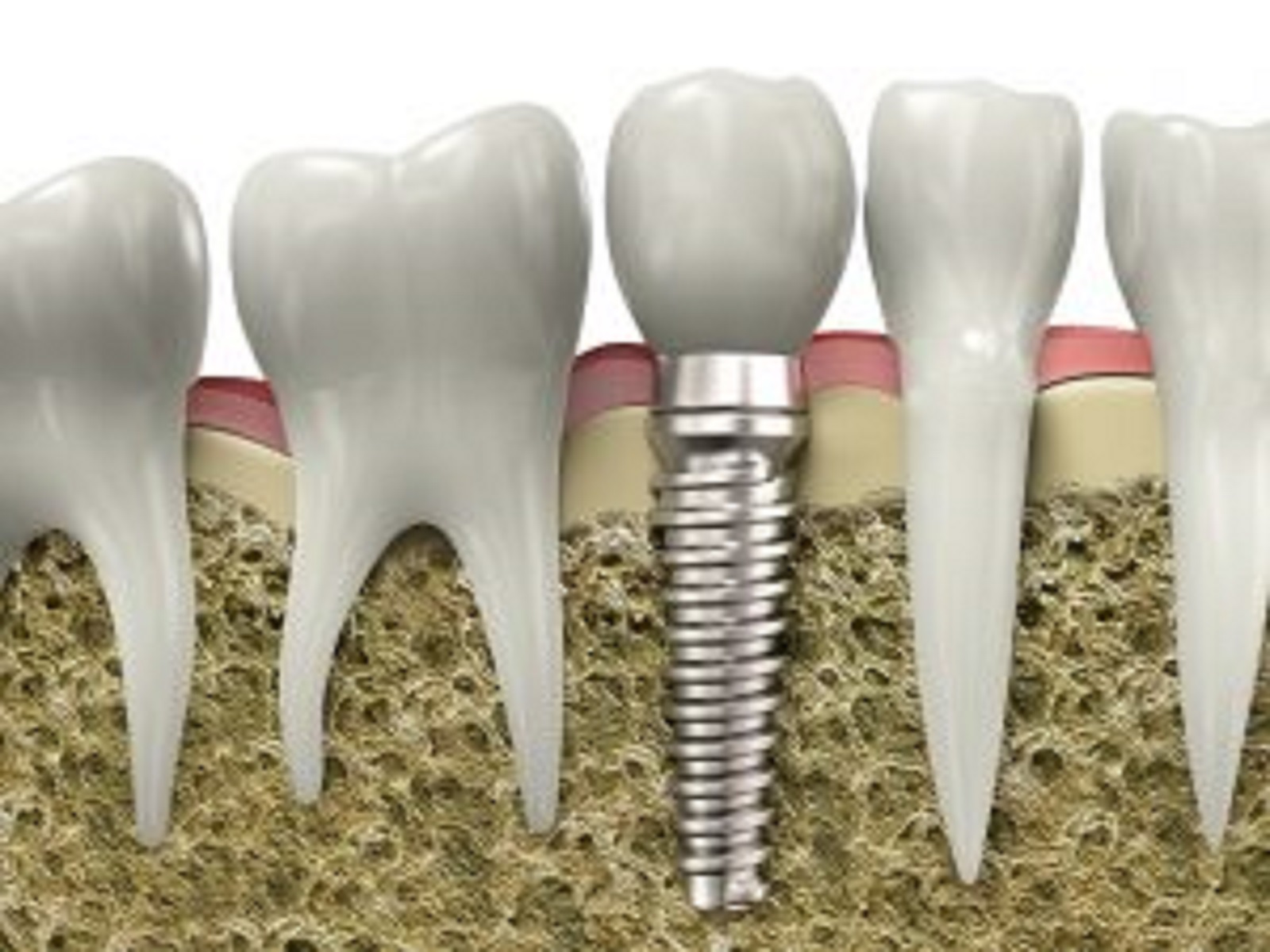 dental implant timeline how long do dental implant procedures take