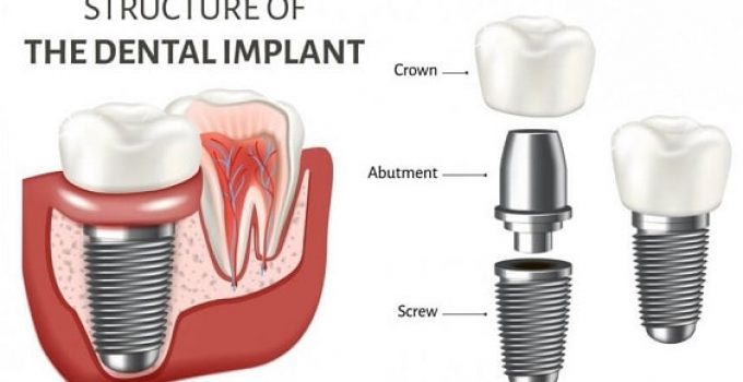 dental implants: replacing missing teeth