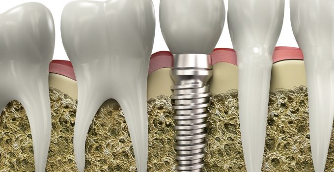missing your back teeth dental implants can prevent big problem