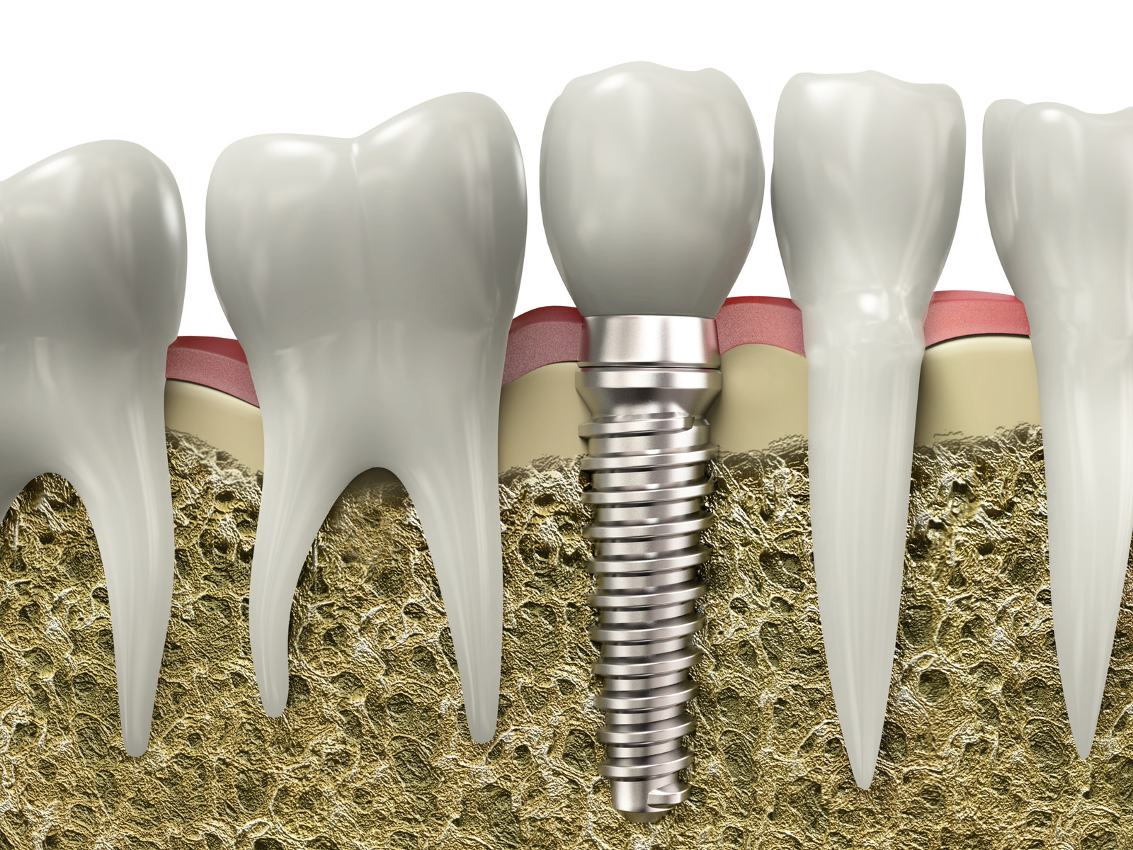 Missing Your Back Teeth? Dental Implants Can Prevent Big Problems