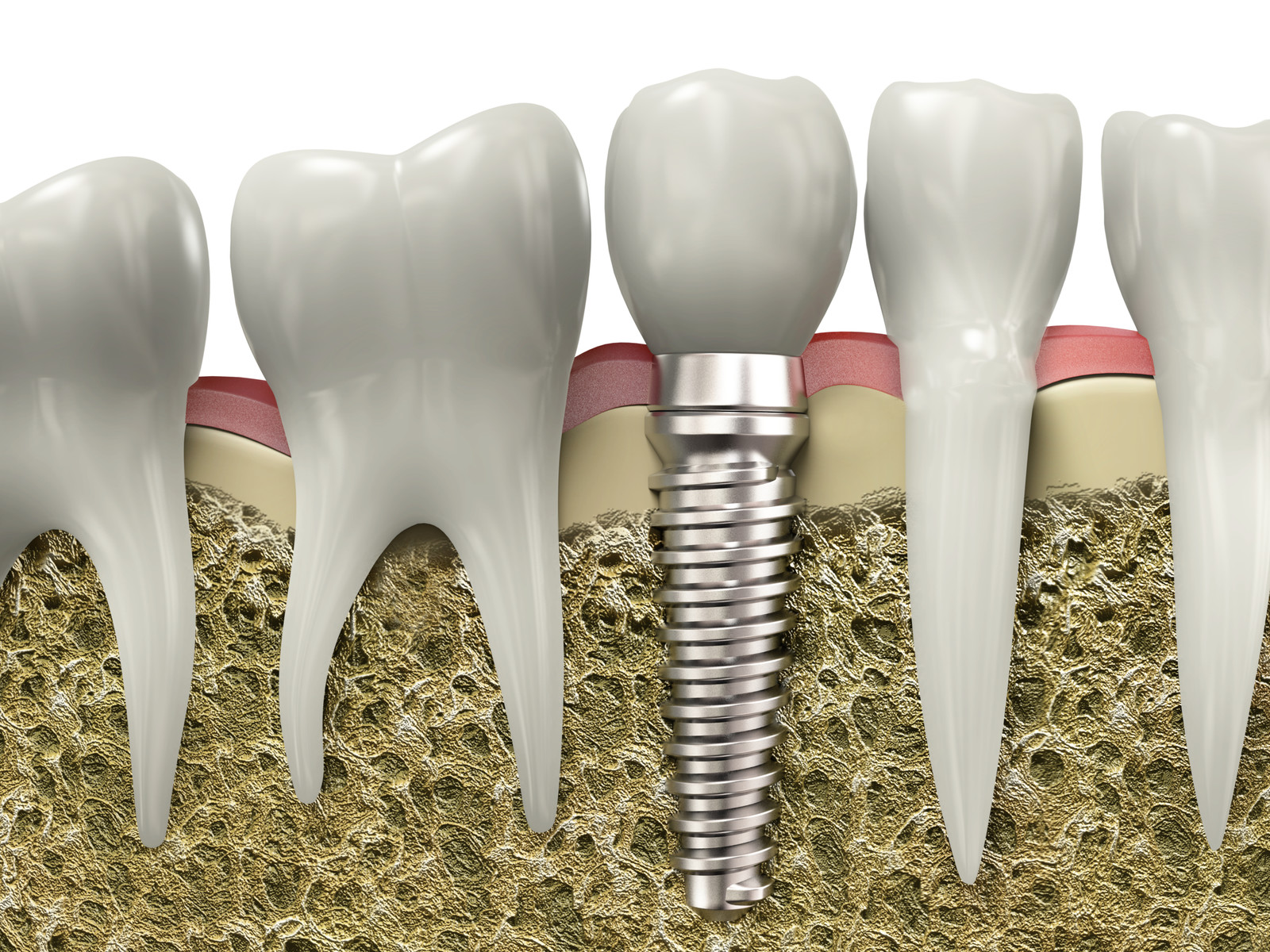 missing your back teeth dental implants can prevent big problem
