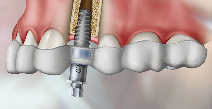 the benefits of guided implant surgery
