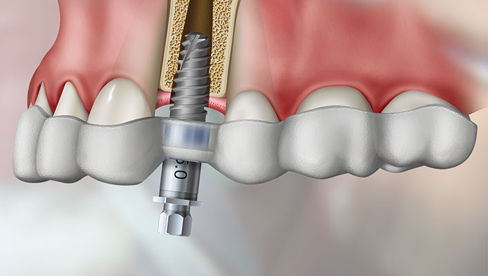 the benefits of guided implant surgery