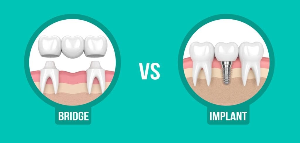 what are my options to replace missing teeth