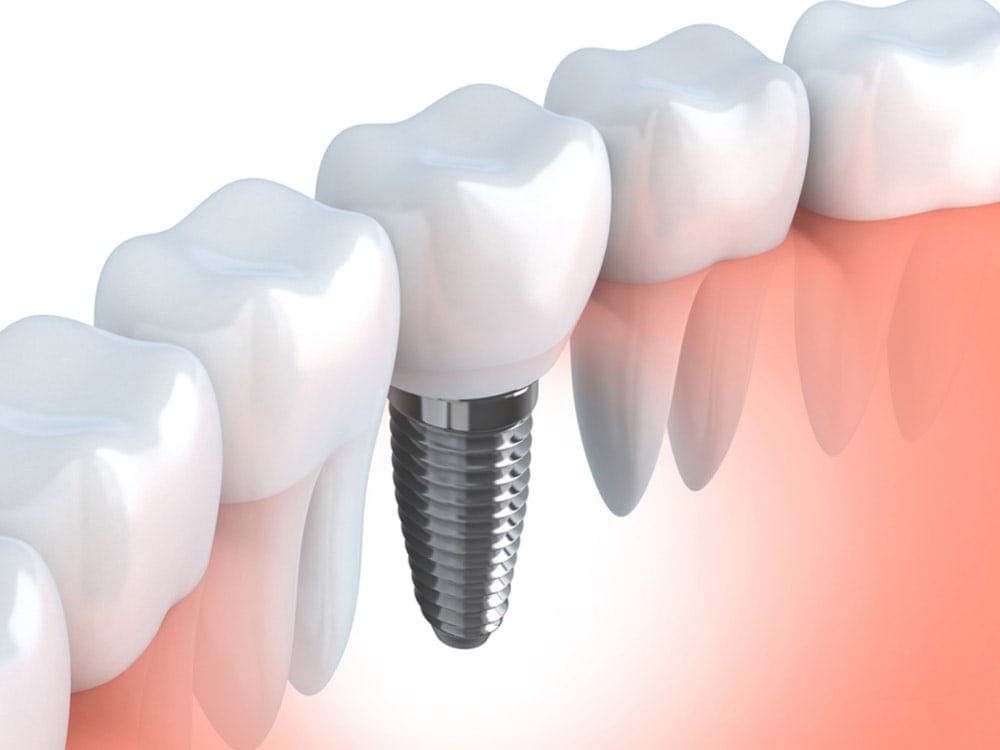 dental implants in millwoods