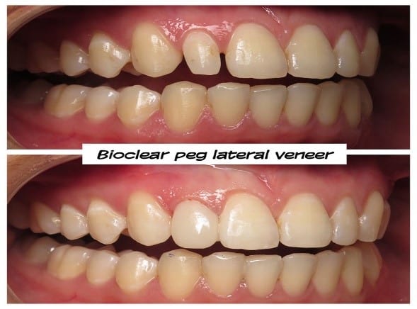 bioclear peg lateral veneer