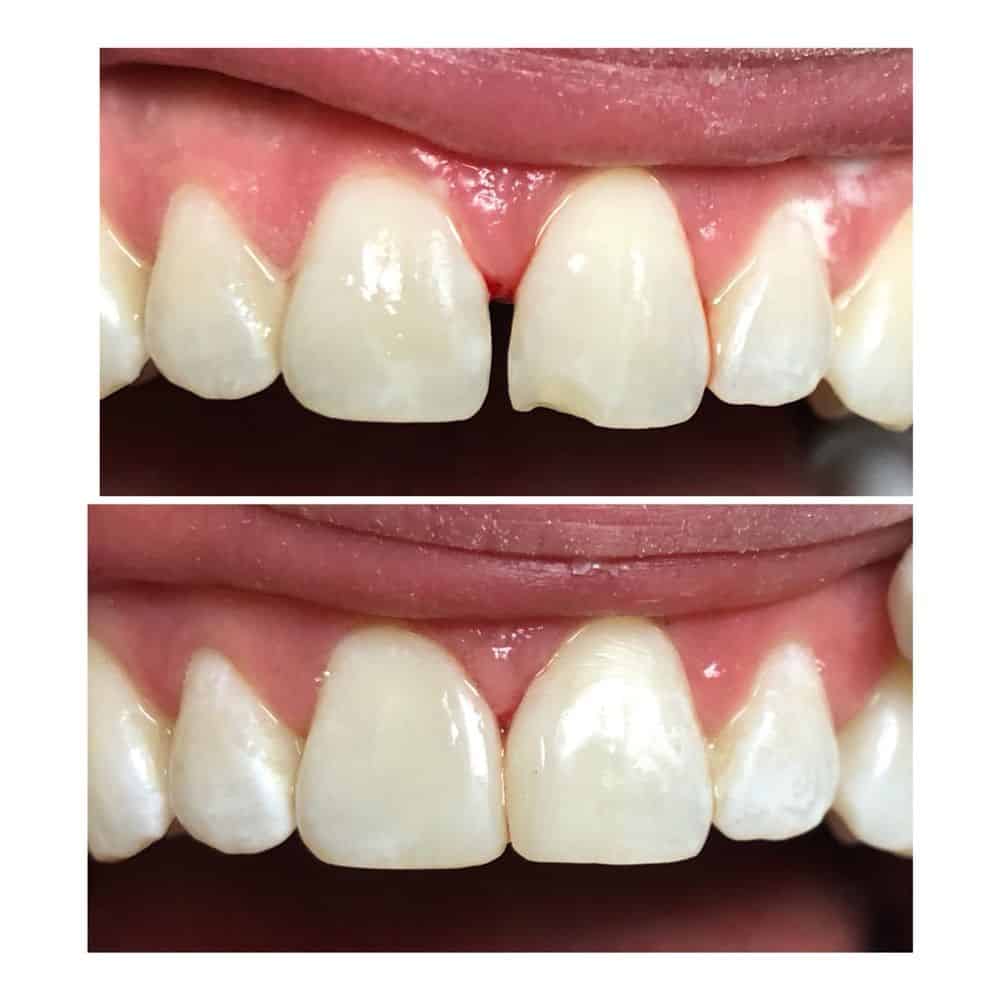 broken teeth correction