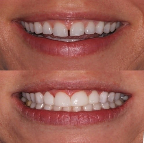 diastema closure