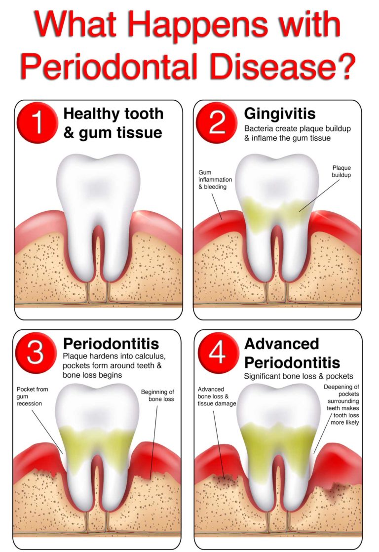 The Importance of Periodontal Health Agape Dental Clinic Mill Woods