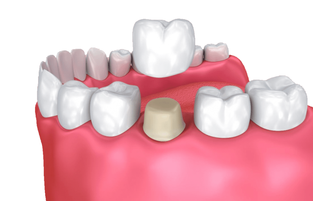 dental crowns in millwoods