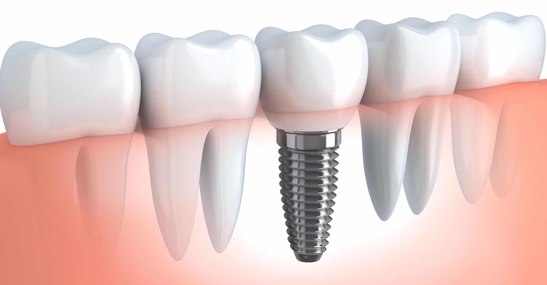 dental implants near me