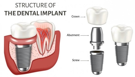 dental implants replacing missing teeth