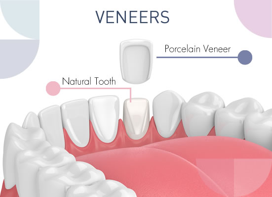 how to restore your smile with porcelain veneers