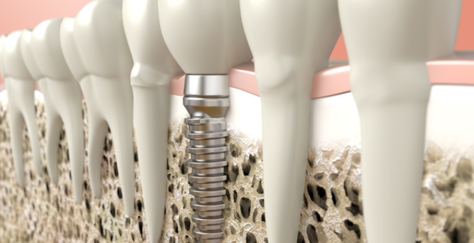 why are dental implants so popular