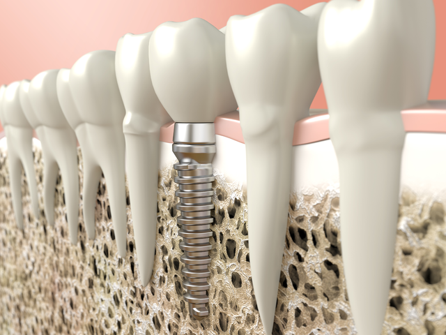 Why are Dental Implants so Popular