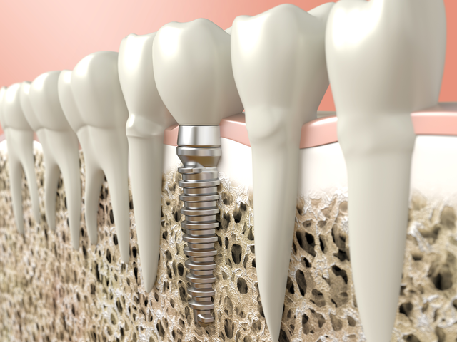 why are dental implants so popular