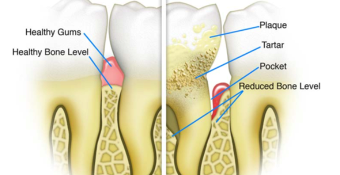 why periodontal health matters 