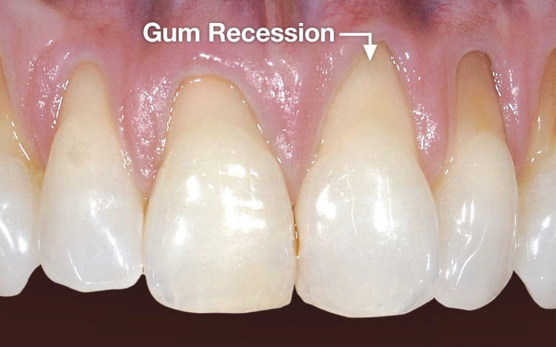 gumrecession