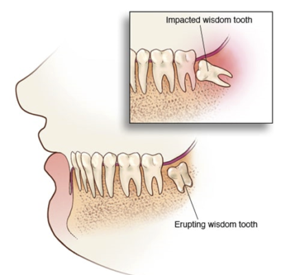 wisdom tooth eruption what can happen when they’re impacted