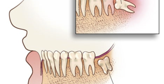 wisdom tooth eruption what can happen when they’re impacted