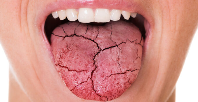 the truth about dry mouth