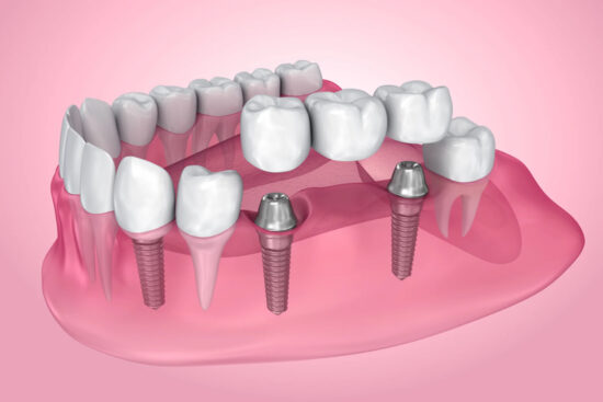 Dental Implants vs Dental Bridges