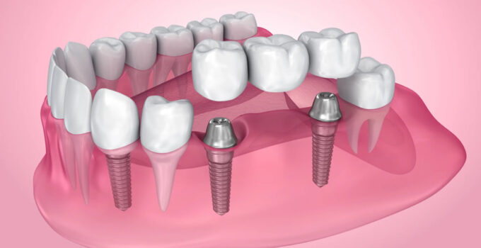 Dental Implants vs Dental Bridges