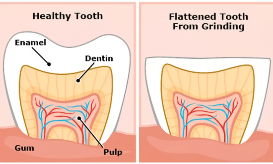 the truth about bruxism