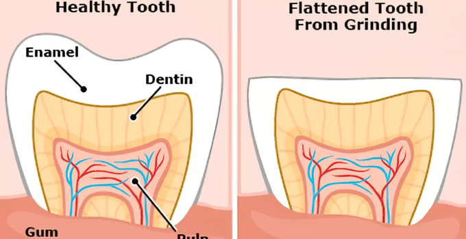 the truth about bruxism