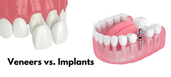 dental implants vs veneers how they compare