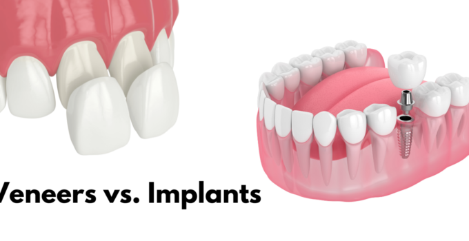 dental implants vs veneers how they compare