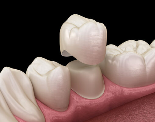 the magic behind dental crowns