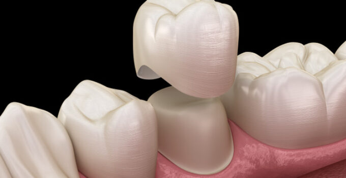 the magic behind dental crowns