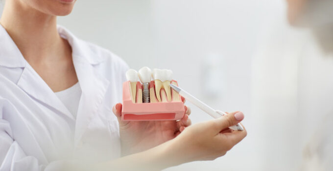 can dental implants be replaced