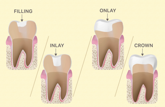 how dental fillings compare to inlays and onlays