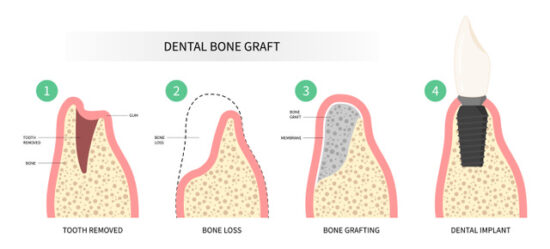 understanding dental bone grafts 