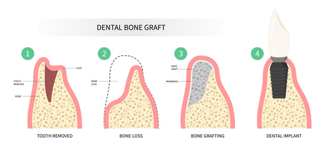 understanding dental bone grafts