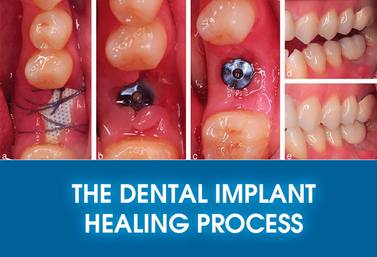 dental implants in Millwoods
