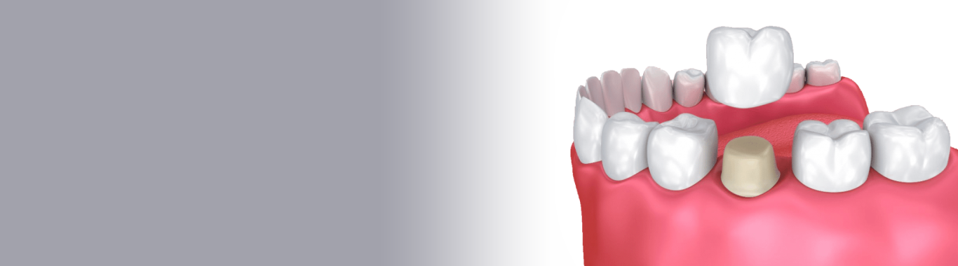 dental crowns in millwoods