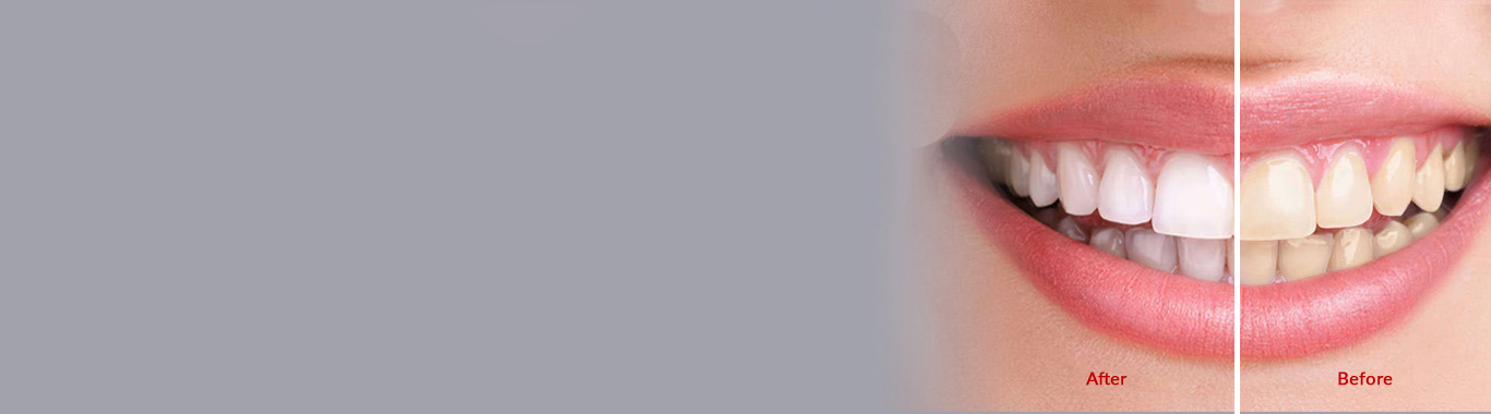 teeth whitening in millwoods